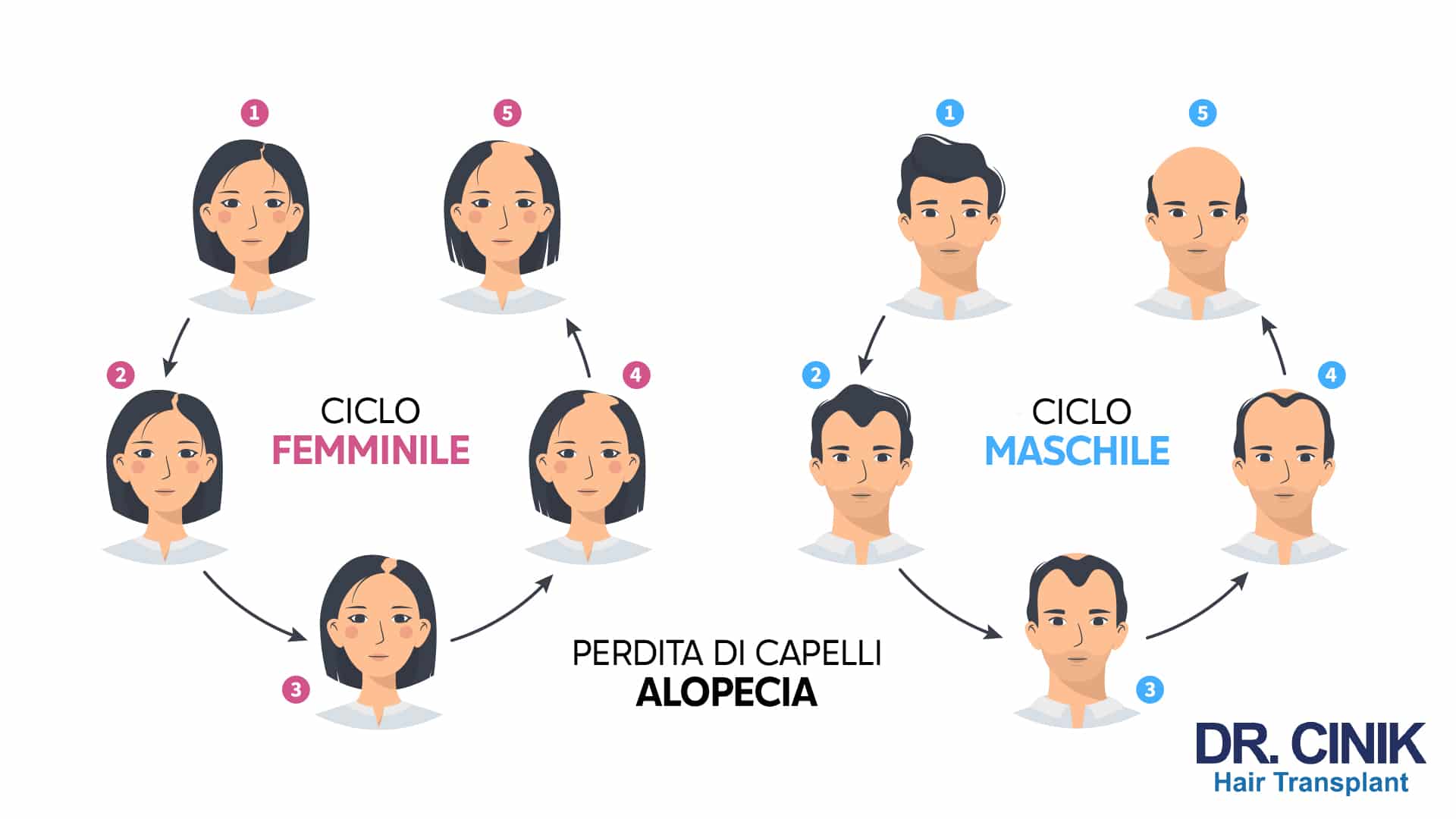 Infografica che confronta il ciclo femminile e il ciclo maschile della perdita di capelli e dell'alopecia, ciascuno rappresentato in cinque stadi numerati