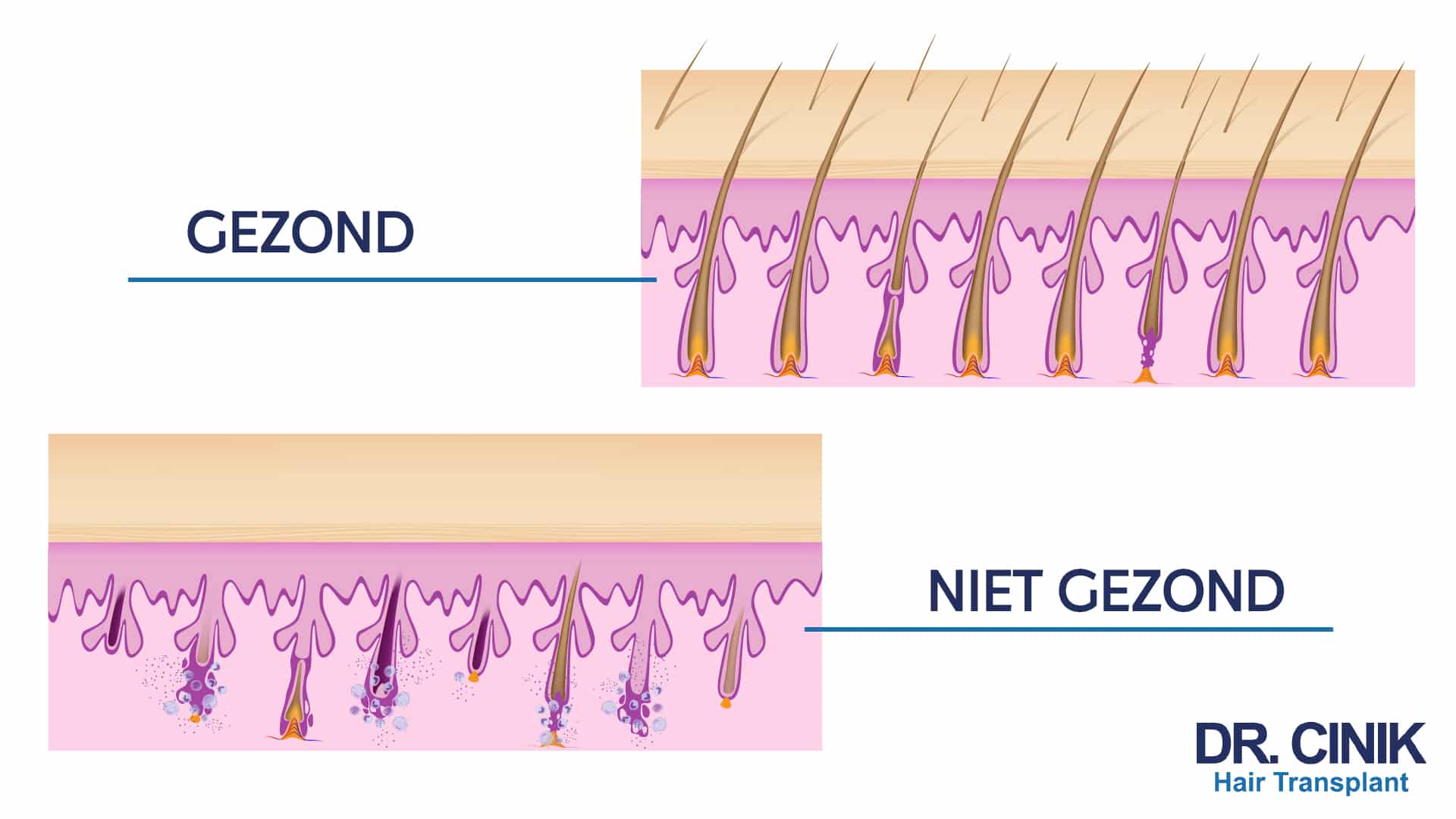 Illustratie met bovenaan het label GEZOND, een dichte huidlaag met stevig verankerde haarzakjes, en onderaan het label NIET GEZOND, met verschraalde haarzakjes waarvan de wortel afbrokkelt